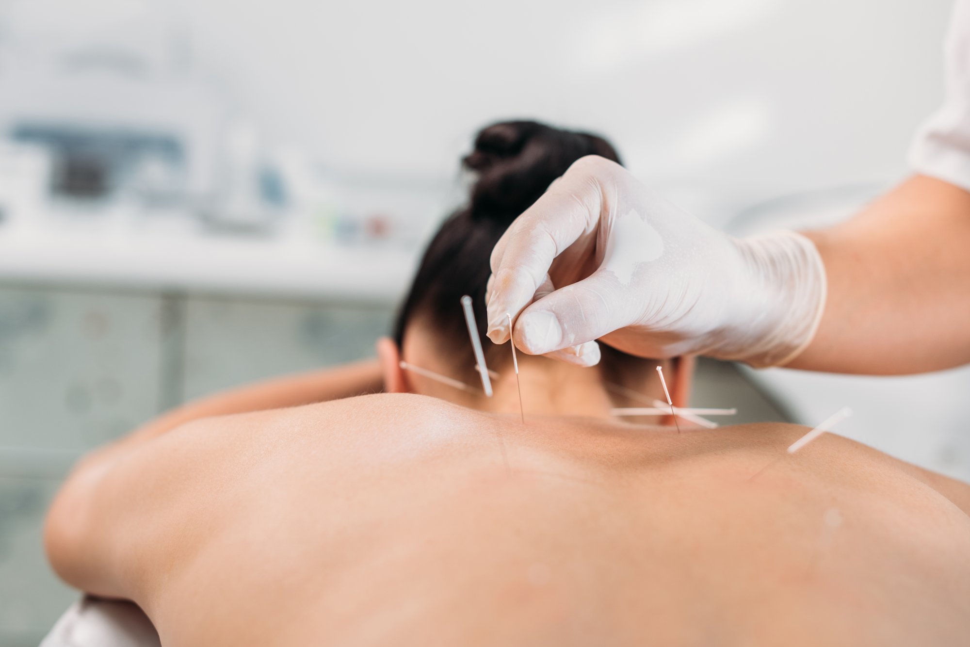 dry-needling-bellevue-wa