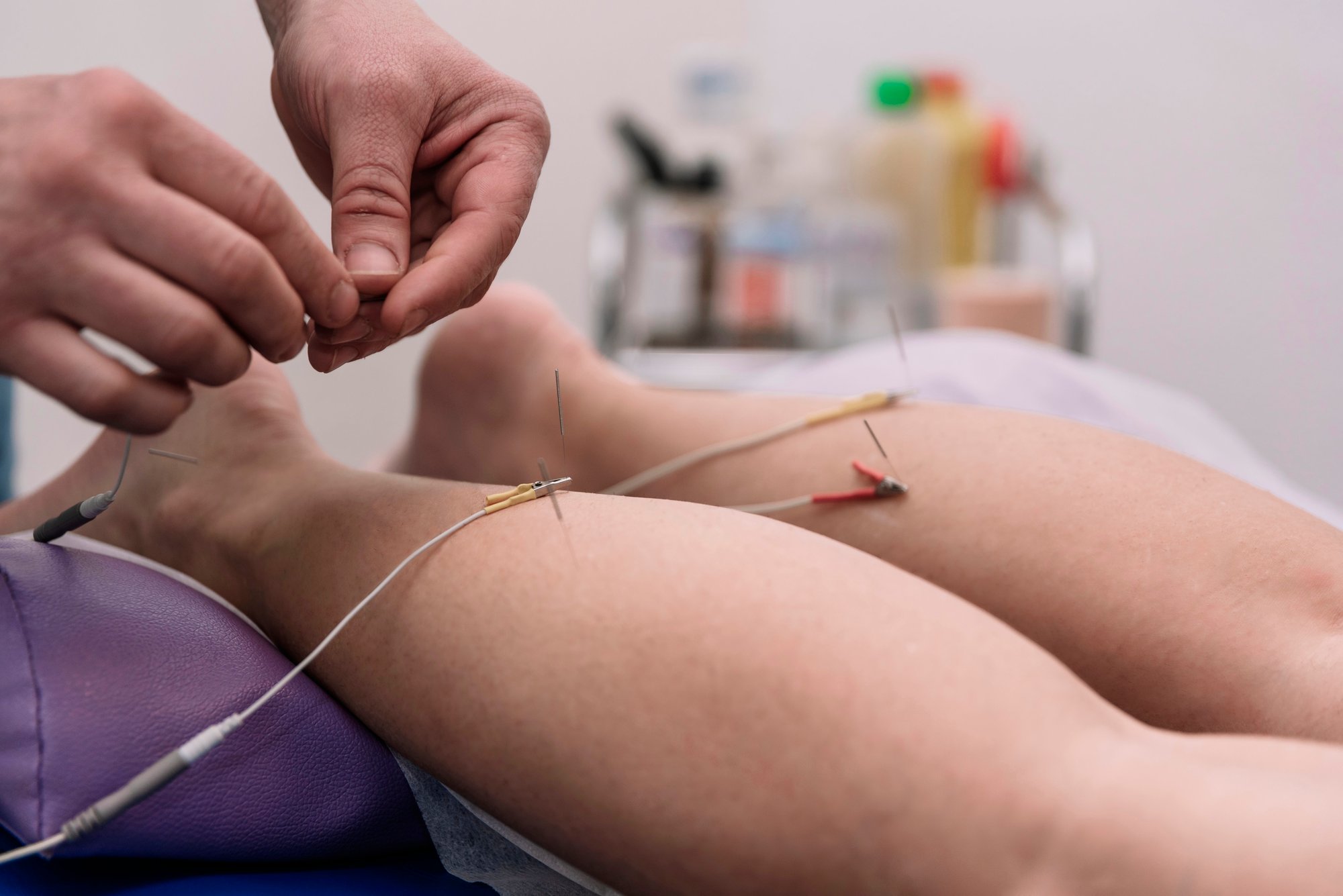 dry-needling-bellevue-wa