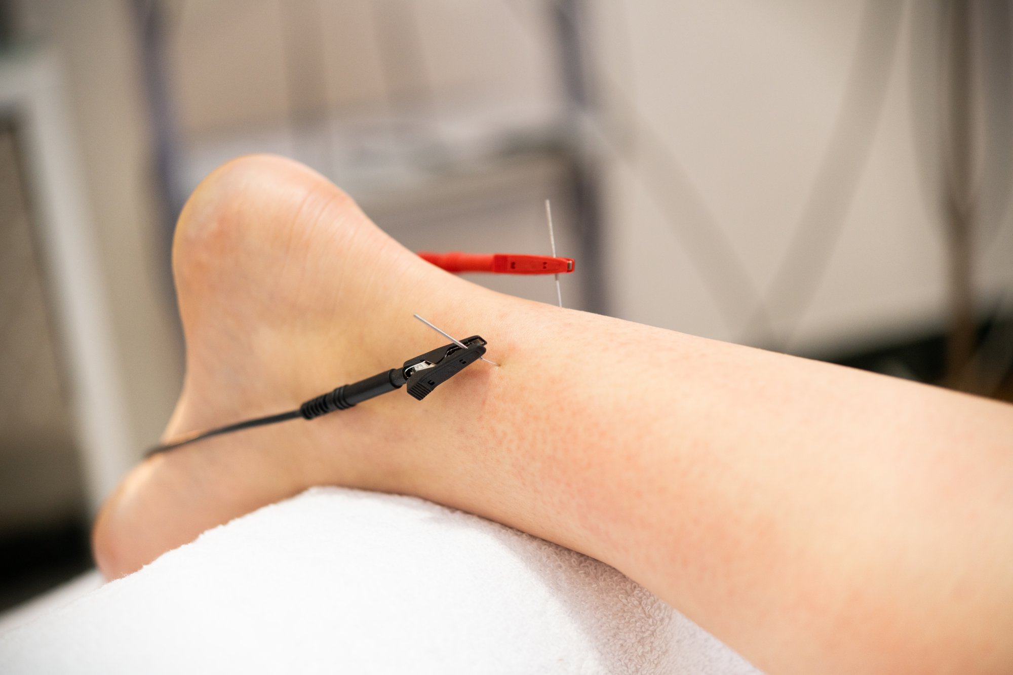 dry-needling-bellevue-wa