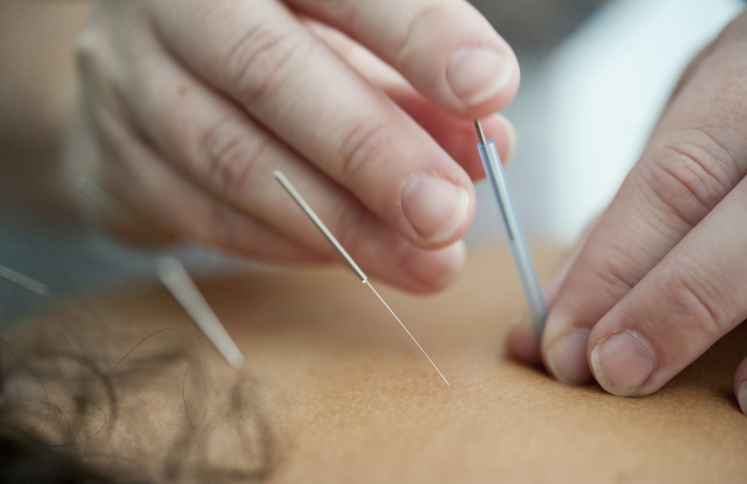 dry-needling-bellevue-wa